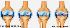 Boleči sklepi - artroza- magus.si